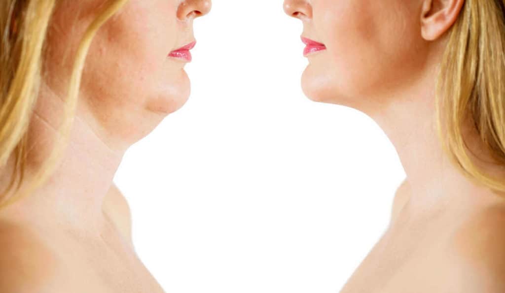Double Chin treatment Holland Park before and after results
