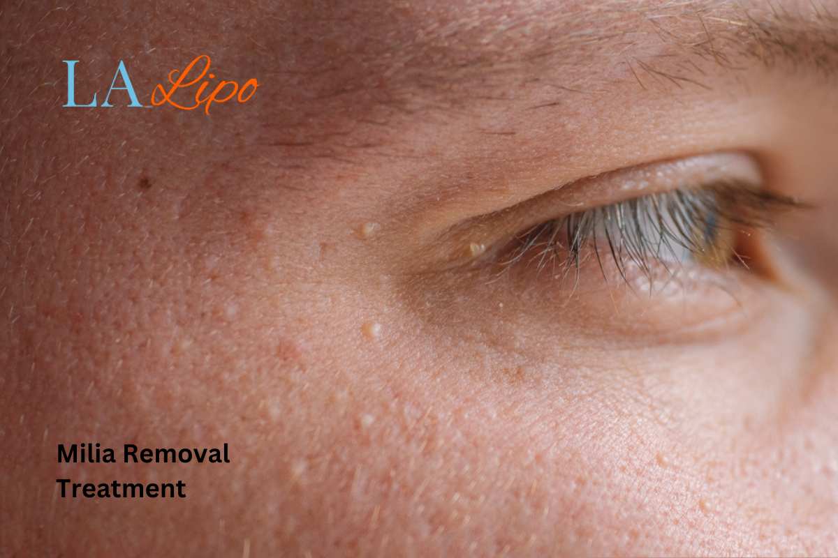 Cryopen Milia Removal: Is It the Easiest and Safest Option Holland Park?
