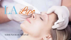 Woman receiving Actinic Keratosis Removal Treatment Holland Park