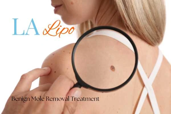Why getting moles removed Holland Park can boost your confidence!