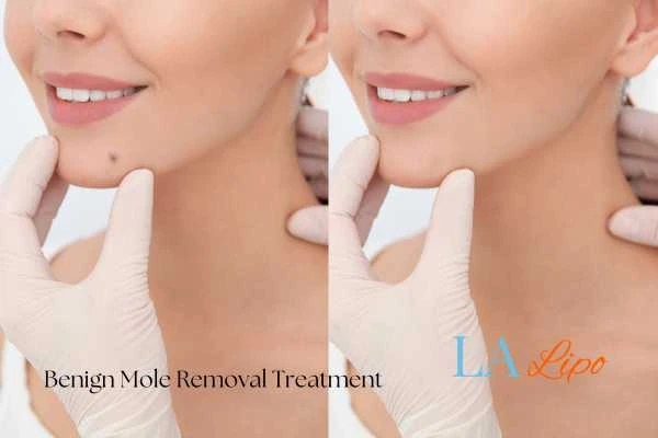woman's before and after mole removal Holland Park results