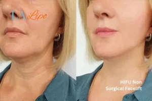 hi-fu for wrinkles Holland Park before and after results
