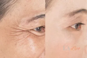 Before and after results of woman - HI-fu wrinkles reduction treatment Holland Park