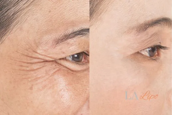 Before and after results of woman - HI-fu wrinkles reduction treatment Holland Park
