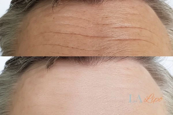 results of HIFU Holland Park on mans forehead to help reduce lines and wrinkles