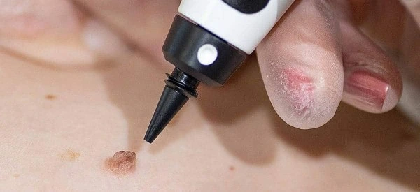 skin tag removal using cryopen Holland Park
