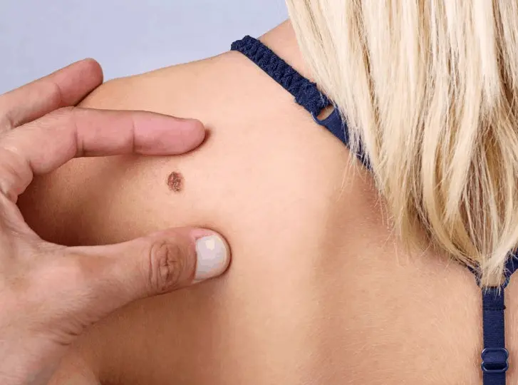 woman having mole removal Holland Park consultation before treatment.