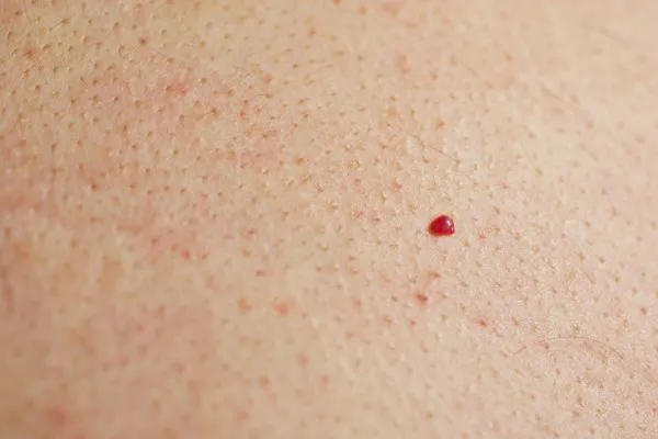 close up of a cherry angioma Holland Park