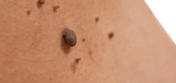 image of a skin tag Holland Park