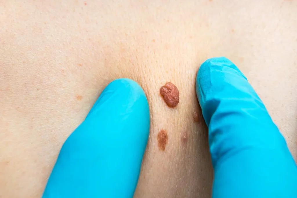 Consultant examining a skin tag Holland Park