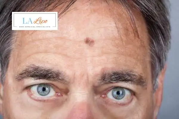 Solar Lentigo Removal Holland Park image of man with mark on his forehead