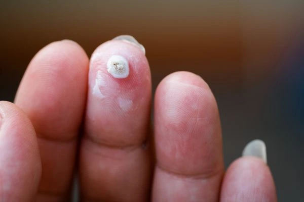 wart on person finger - cryotherapy to treat from LA LIPO Holland Park