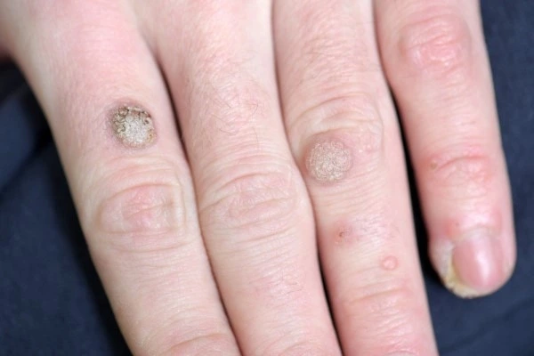 photo of warts on person hand - see wart removal Holland Park from LA LIPO