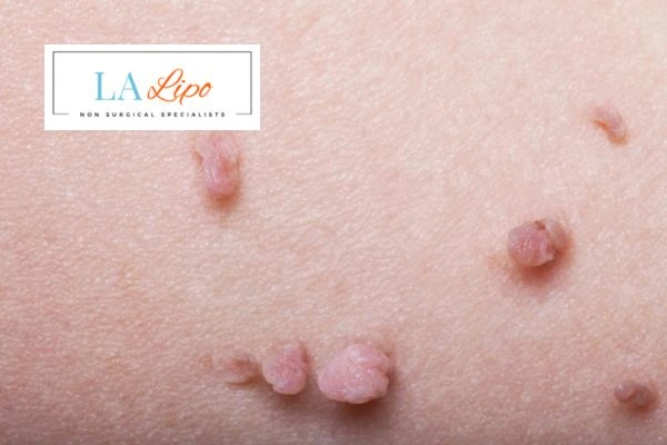 Does cryopen skin tag removal Holland Park hurt? Find out now call our team today!