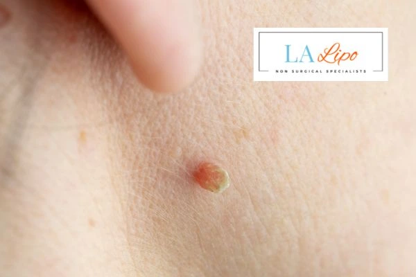 Book skin tag removal Holland Park today speak to our team now!