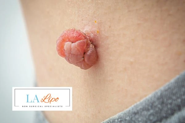Interested in skin tag removal Holland Park? Concerned about the pain? Find out more today!