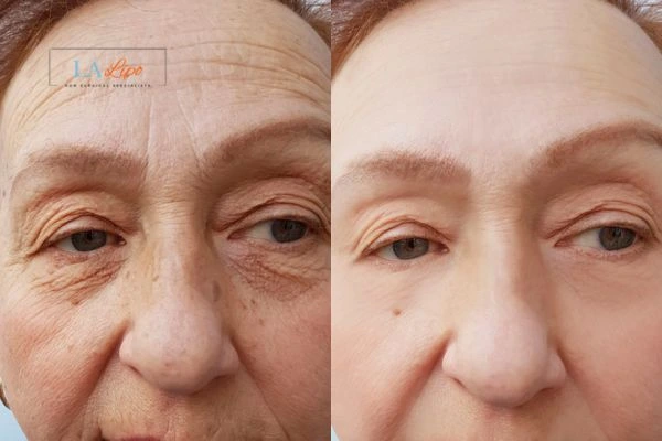 The powerful benefits of Morpheus8 Treatment Holland Park - Call Our team today!