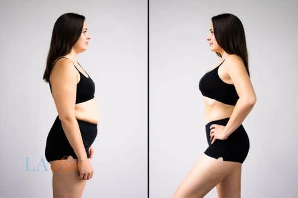 Picture of womans before and after using LA-EMS body sculpting to improve her core strength Holland Park