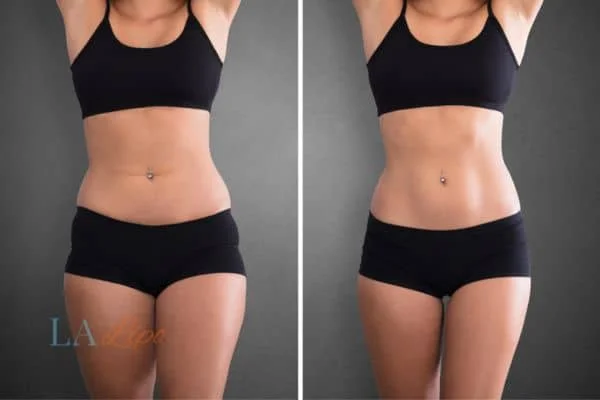 before and after results of non-surgical treatment to help a woman's body image and mental health Holland Park