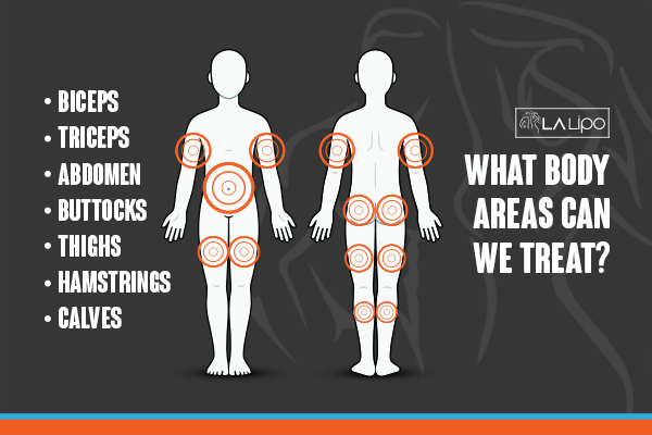 Diagram to show areas you can have LA-EMS Body Sculpting Treatment Holland Park