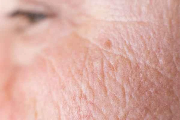 close up picture of a woman's face showing an age spot Holland Park