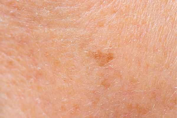 close up picture of age spots Holland Park