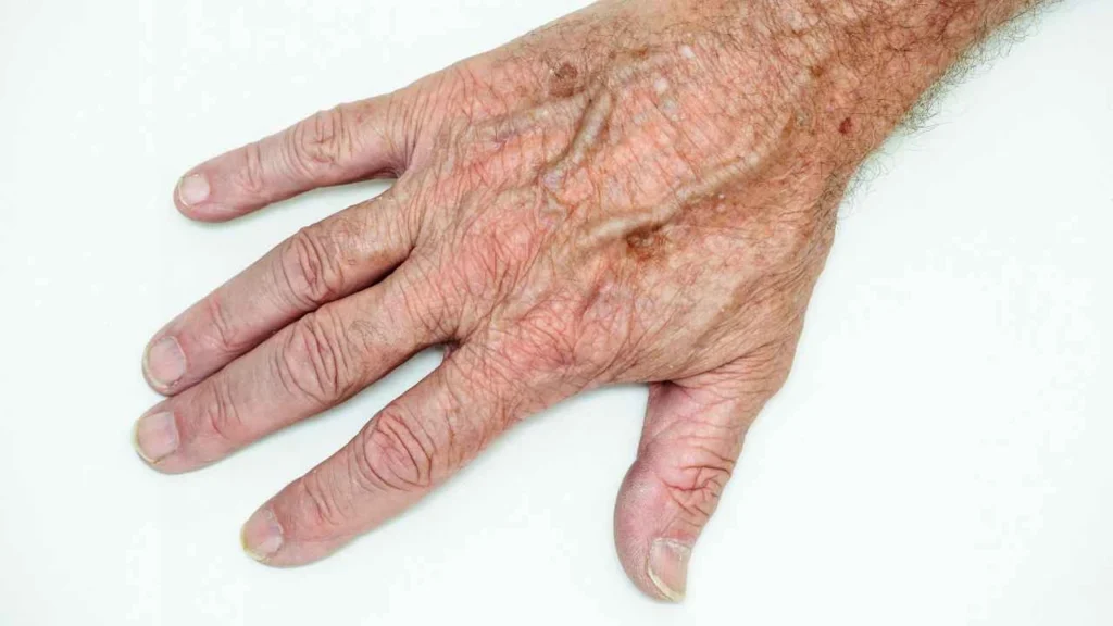 Male hand showing age spot Holland Park