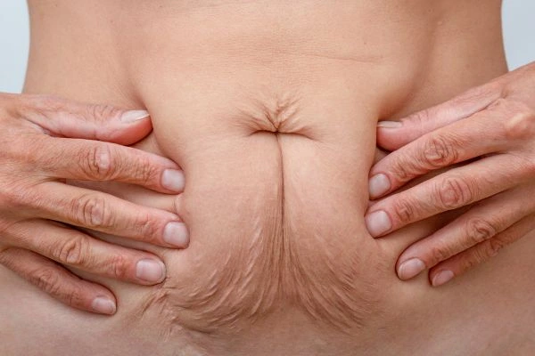 Image of a woman's stomach with loose skin - example of skin tightening Holland Park options