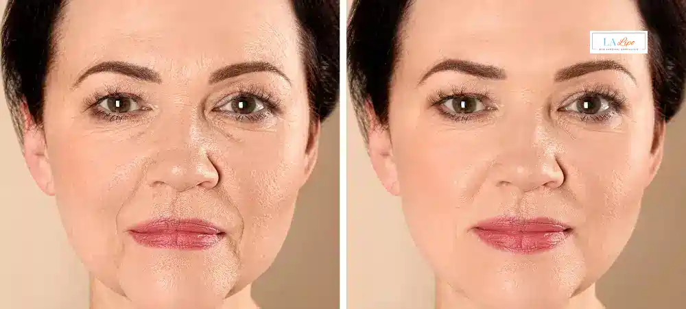 How Long Does It Take to See Results and How Long Do They Last Holland Park?